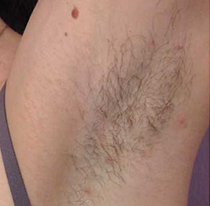 Columbia Laser Hair Removal About You Aesthetics